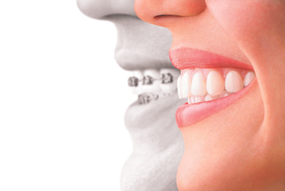 Invisalign, Ashley Laird DDS, Tyler TX, clear aligners, discreet orthodontics, comfortable braces, teeth straightening, oral health, orthodontic treatment